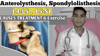 Anterolisthesis spondylolisthesis L5s1 spondylolisthesis Treatment Exercise Low back pain [upl. by Kalasky759]