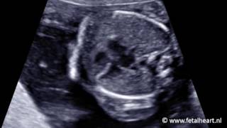 Fetal heart Academy  VSD 1 four chamber view 18 weeks gestation [upl. by Wallinga]