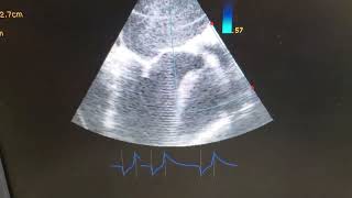 Échographie TransOesophagnienneETO Sténose Mitrale Maladie Aortique au Cameroun 25 ans Siemens [upl. by Tabby]