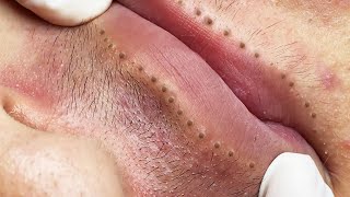 Lips Blackhead removal Video 45 Blackheads blackheadsremoval sebum [upl. by Alleyne]