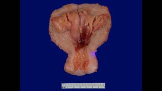 Pathology  dr Nafeaa  Neoplasia كل ما تريد عن الأورام [upl. by Oliviero]