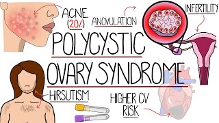 Polycystic Ovary Syndrome Made Easy PCOS Explained [upl. by Babita]