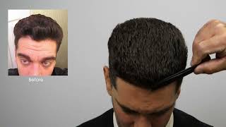 1500 Graft Hair Transplant Result [upl. by Charbonneau454]