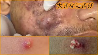 角質除去は顔を治療します Exfoliation will treat the face [upl. by Lacagnia167]