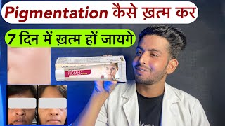 Pigmentation 2 दिन में ख़त्म  Pigmed cream  Pigmed cream kaise use kare  Depigmentation cream use [upl. by Eillil518]