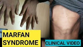 Marfan syndrome  clinical video [upl. by Seavir]