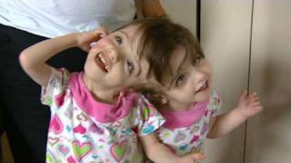 Conjoined Twins Twin Girls A Medical Wonder [upl. by Daeriam]