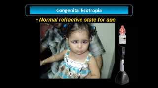 Congenital Esotropia [upl. by Llednew53]