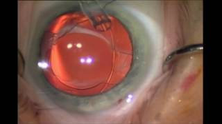 CCS in hingedbased accommodative intraocular lenses  Video S1 [upl. by Ellenuahs]