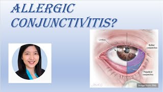 Dr Ding  Allergic Conjunctivitis [upl. by Lasyrc505]