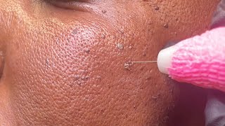 DPN Dermatosis Papulosa Nigra Removal [upl. by Nannie]