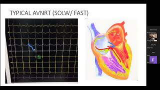 EP BASICS I ARRHYTHMIA I INTRACARDIAC TRACINGS [upl. by Atsilac985]