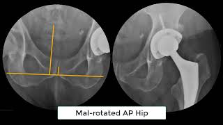 Radlink 323 Technology Restoring Anatomical Alignment during Hip Replacement Surgery [upl. by Akiria]