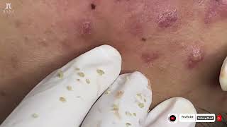 Big Cystic Acne Blackheads Extraction Blackheads amp Milia Whiteheads Removal Pimple Popping [upl. by Fantasia]