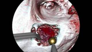 Enhancing Realism of Wet Surfaces in Temporal Bone Surgical Simulation [upl. by Rafter116]