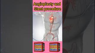 Angioplasty technique  Stent and Angioplasty procedure shorts [upl. by Dyolf]