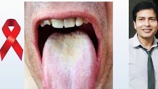 white Tongue  Synonyms  Lymph nodes क्या मैं positive हो जाऊंगा [upl. by Arlina]