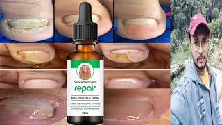 onychomycosis repair  nails repair serum growth nails  honest review [upl. by Nodal]