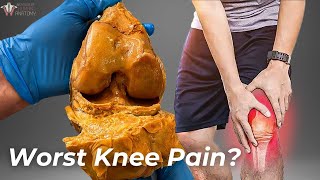 How Arthritis Destroys Your Knees [upl. by Annayehc671]