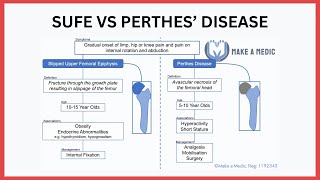 Slipped Upper Femoral Epiphysis SUFE vs Perthes Disease [upl. by Herman]