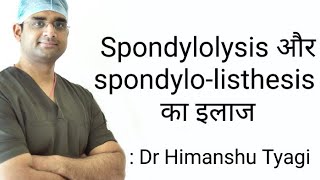 spondylolysis spondylolisthesis and treatment [upl. by Aihc]