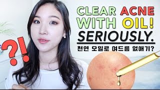 CLEAR ACNE WITH OIL • BEST Oils for Acne Prone Skin [upl. by Nicol]