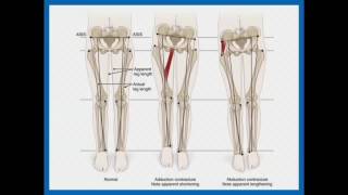 Clinical and Radiological Assessment of Skeletal Malalignment  Dr Farokh Wadia [upl. by Llahsram]