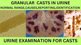 GRANULAR CASTS IN URINECAUSES SYMPTOMS TREATMENT OF GRANULAR CASTS IN URINE EXAMINATION IN HINDI [upl. by Mariele109]