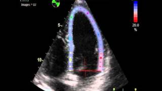 IS EJECTION FRACTION NORMAL 2  STRAIN VALUE  ECHOCARDIOGRAPHY cardiac ultrasound [upl. by Grete]