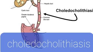 choledocholithiasis [upl. by Nnaylloh]