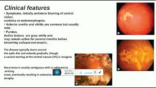 idiopathic chorioretinopathies [upl. by Behlke836]