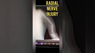 Radial Nerve Injury after Humerus Fracture Wrist amp Finger Drop  Dr Prateek Joshiortho fracture [upl. by Anstice185]