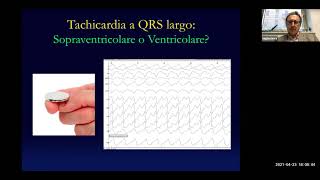 GIS4Plus  Update sullextrasistolia ventricolare in Medicina Interna [upl. by Kristin]