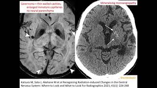 67 Radiation induced cavernoma and mineralising microangiopathy popcorn capillary teleangiectasia [upl. by Thorvald]