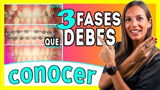 Brackets proceso 𝗠𝗘𝗦 𝗮 𝗠𝗘𝗦 📆 Las ③ 𝐄𝐓𝐀𝐏𝐀𝐒 del TRATAMIENTO de Ortodoncia  Te lo explico ✅ＦÁＣＩＬ [upl. by Capon]