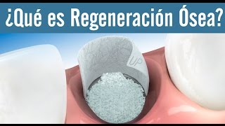 Implantes dentales ¿Qué es Regeneración Ósea [upl. by Ecinehs191]