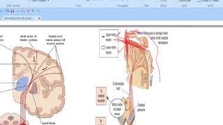 hemiplegia p1 [upl. by Manoff]