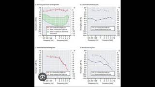 Audiometric fundamentals [upl. by Janenna]