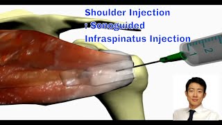 Shoulder Injection Therapy The Ultrasoundguided Approach for Infraspinatus [upl. by Accebber449]