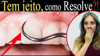 Tratamento Periodontal o que é como RESOLVER RÁPIDO Gengiva Sangrando e Dentes Moles 3 [upl. by Rabbi]