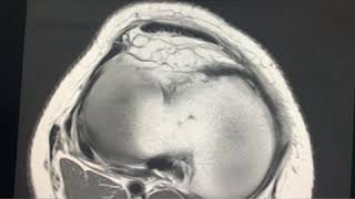 Case of the day  Medial patellar Plica Syndrome  multipartite patella dorsal patellar defect [upl. by Tnattirb738]