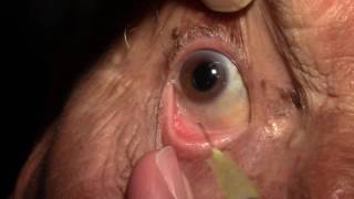 Right Intravitreal Injection of Eylea [upl. by Mathre]