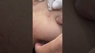 Dry Needling for Upper Trapezius in Severe Cervical Canal Stenosis  Chiropractic Treatment Kolkata [upl. by Ecirtnahs56]