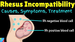 Rhesus Incompatibility  Rh Incompatibility in Pregnancy – Causes Symptoms Diagnosis amp Treatments [upl. by Ecille986]