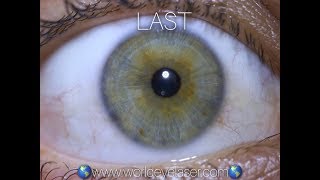 Worldeyelaser treatment for changing eye color WORLDEYELASER CLINIC [upl. by Eloc]