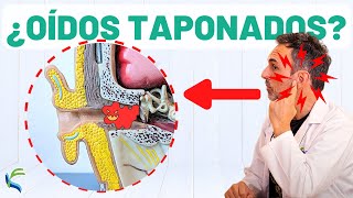 ¿OÍDOS TAPONADOS 🙉 Remedio natural para eliminar el tapón👂 [upl. by Trueman]