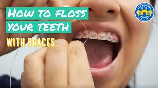 How to Floss with Braces  3 Flossing Tips [upl. by Ahsaekal]