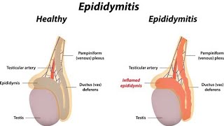 Epididymitis treatment in hindi or english [upl. by Neeleuqcaj686]