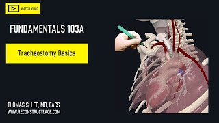 Tracheostomy Basics  ENT perspective  Avoid common complications 103A Didactic [upl. by Fogg256]