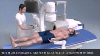 Lithotripsie extra corporelle  Extracorporeal Shock Wave Lithotripsy Montpellier [upl. by Narret]